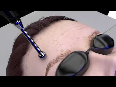 Regenixion (ION 680 technologie)