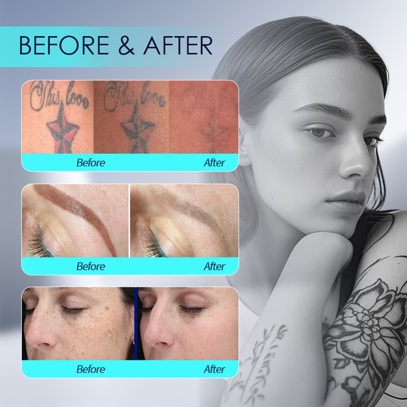PicoCura AI Medical tattoo & pmu verwijderen - Afbeelding 3