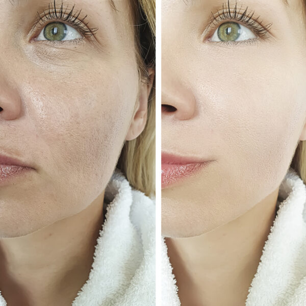 Cursus skinbooster incl. Dermashot