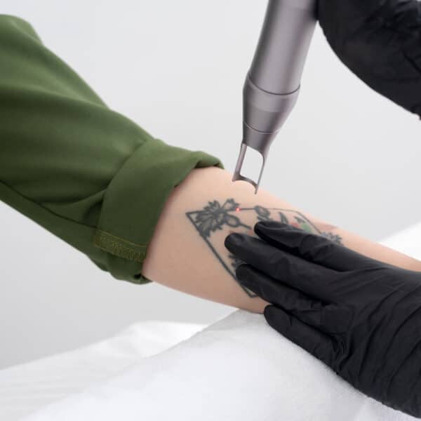 Cursus Tatoeage Verwijderen met de Picolaser (2-daags)