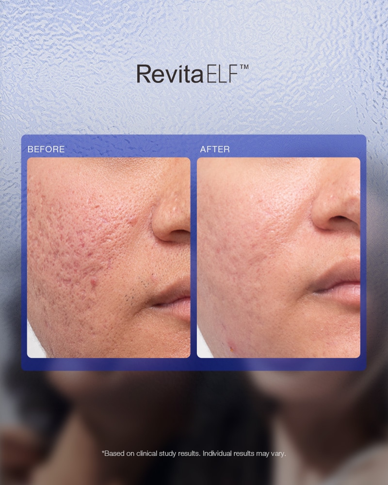 RevitaELF™ Laser Opleiding: Specialist in 1565nm Fractional Laser voor Haar & Huid - Afbeelding 7