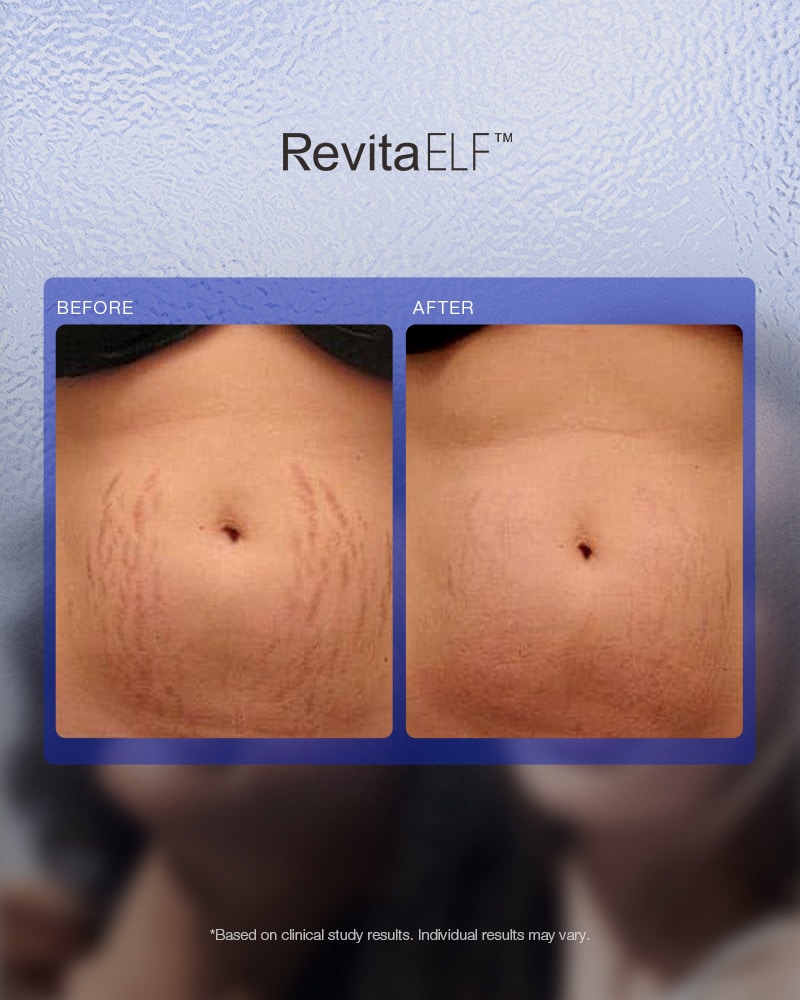 RevitaELF™ Laser Opleiding: Specialist in 1565nm Fractional Laser voor Haar & Huid - Afbeelding 8