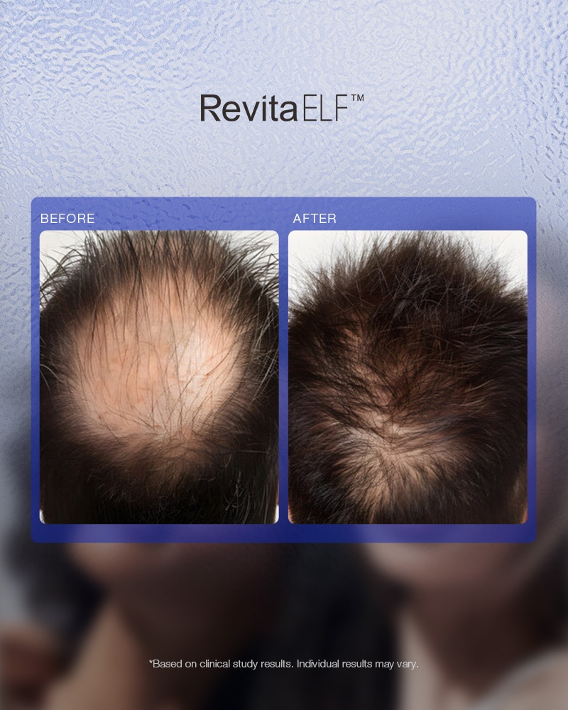 RevitaELF™ Laser Opleiding: Specialist in 1565nm Fractional Laser voor Haar & Huid - Afbeelding 10