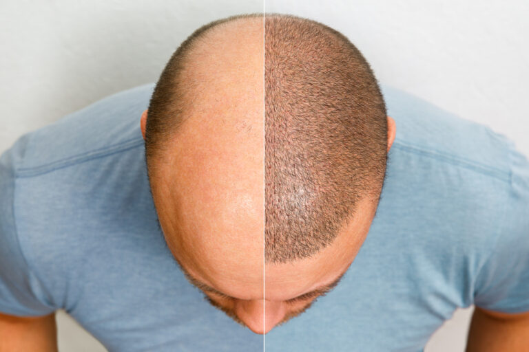 4-Daagse Vakopleiding Micro Haar Pigmentatie (MHP)
