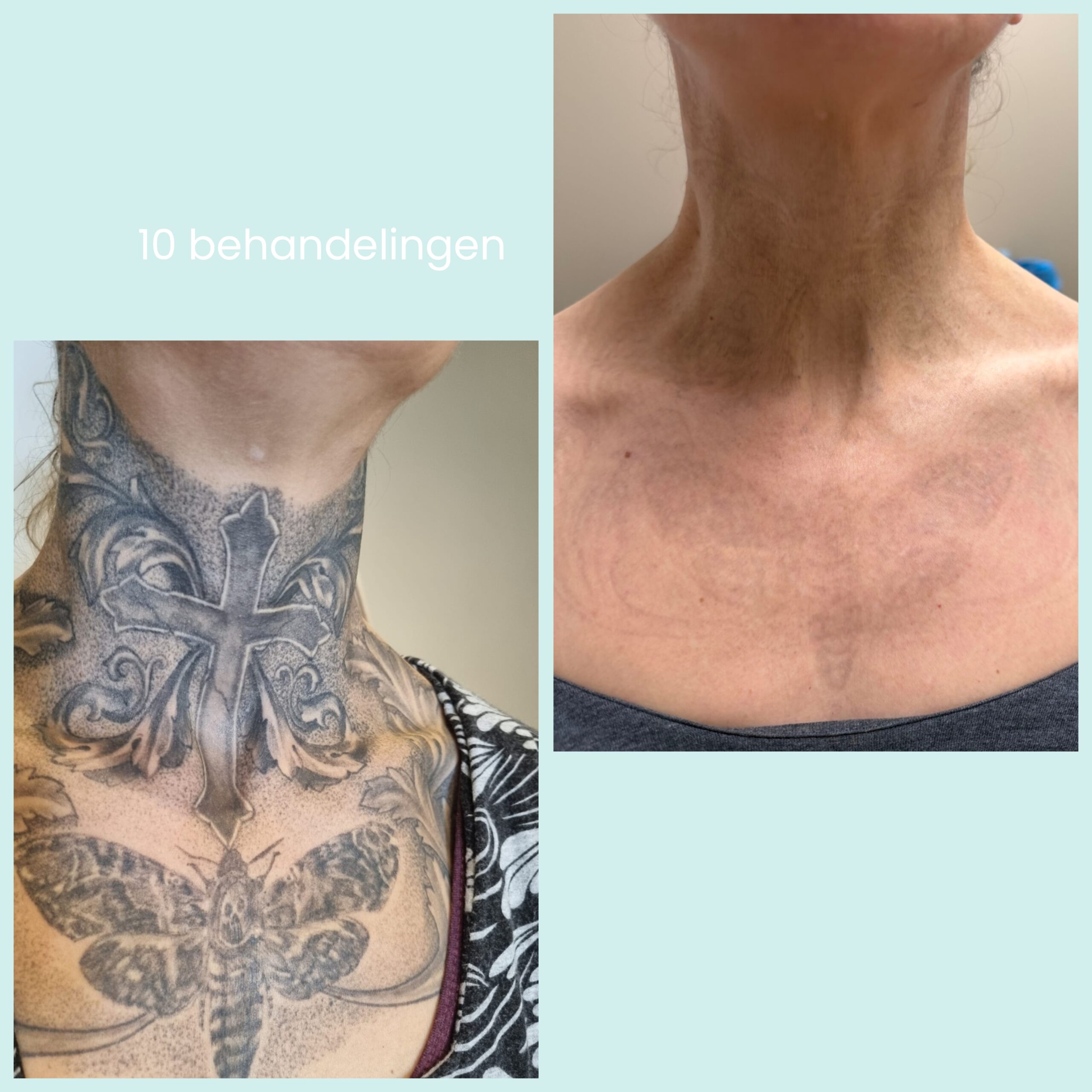 5-Daagse Opleiding Allround Tattoo & PMU Verwijderen met de Picolaser 2