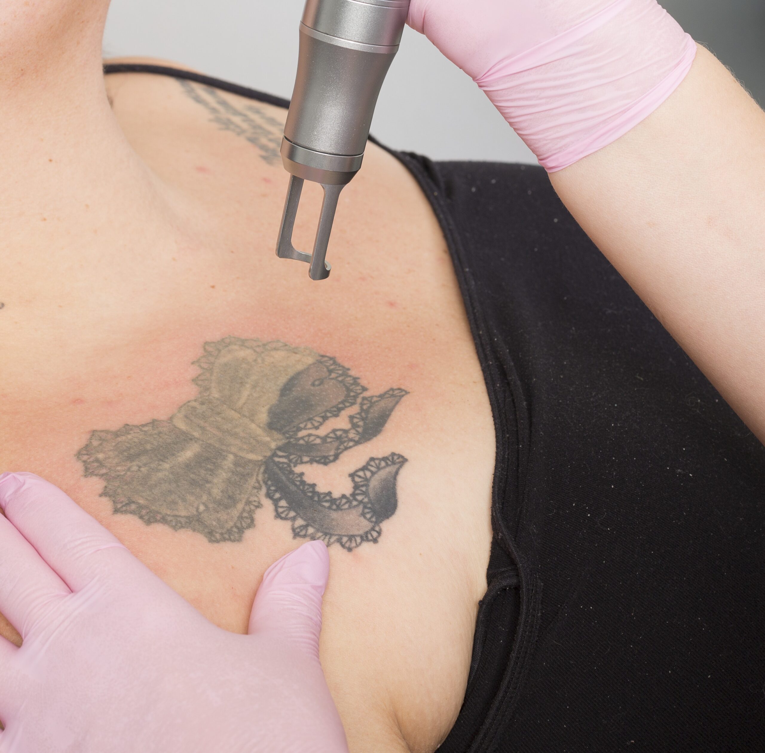 5-Daagse Opleiding Allround Tattoo & PMU Verwijderen met de Picolaser