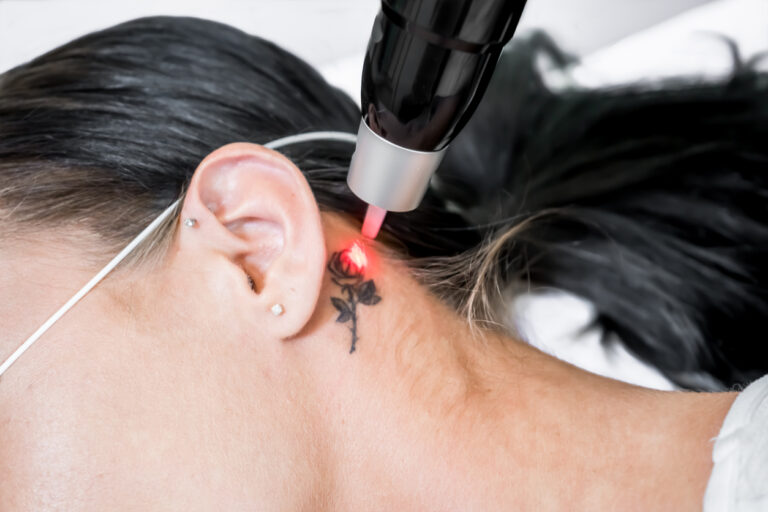 Praktijktraining Tattoo Verwijderen
