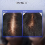 RevitaELF™ 1565nm Laser | Voor Huid & Haargroei 6