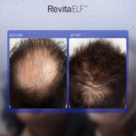 RevitaELF™ 1565nm Laser | Voor Huid & Haargroei 7